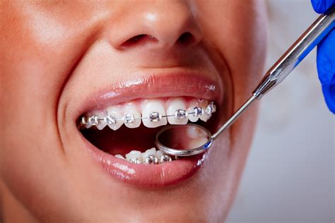 The Advantages of Using Magic Teeth Braces for Teenagers